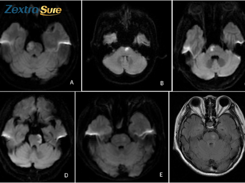 pontine-stroke (2) - Copy